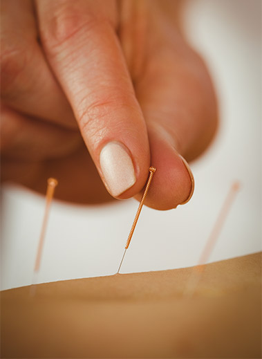 Acupuncture